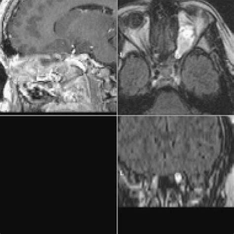 4. The posterior limits of this optic nerve glioma are best seen on MRI... | Download Scientific ...