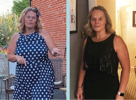 Gastric Balloon Before And After Photos Gastric Balloon Group