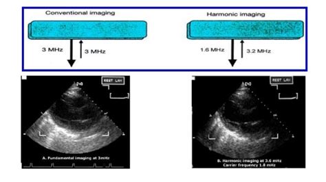 Artifacts in echocardiography