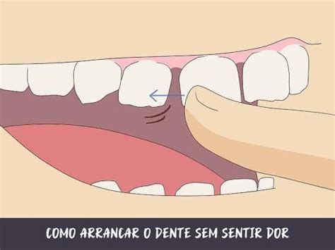 Arranquei Um Dente E Não Para De Doer