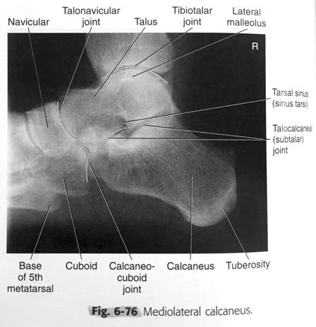 Lateral Calcaneus Flashcards Quizlet