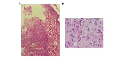 Congenital Cutaneous Langerhans Cell Histiocytosis A Download Scientific Diagram