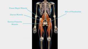 Hip Flexor Tendonitis | Hip Flexor Tendinopathy Exercises