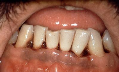 Acute Necrotizing Ulcerative Gingivitis