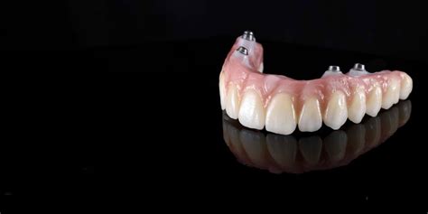 Zirconia Fixed Bridges Canton Oh Full Arch Prosthesis