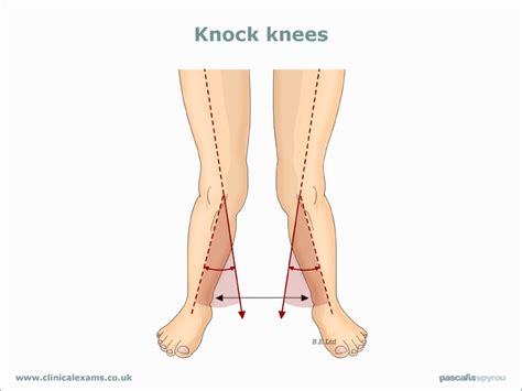 Genu Valgum Anatomy For Msp