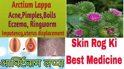 Lappa Major Best Homoeopathic Medicine For Skin Disease Acne Pimples