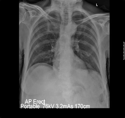 Stercoral Perforation Of The Colon A Potentially Fatal Complication Of Opioid Induced