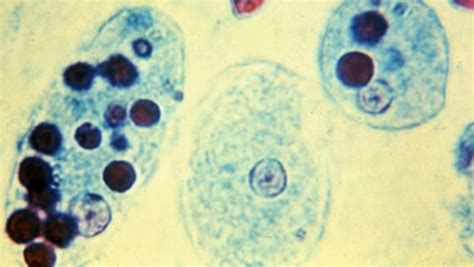 Entamoeba Histolytica Causes