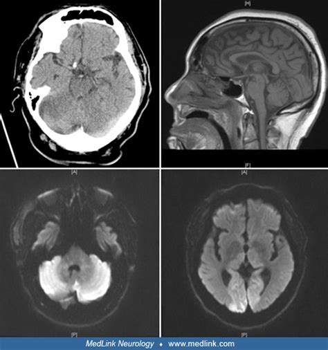 Basilar artery stroke | MedLink Neurology