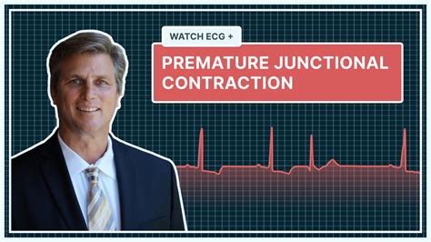 QALY | What a Premature Junctional Contraction (PJC) Looks Like on Your ...