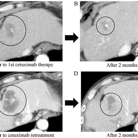 Clinical Course Of A Metastatic Liver Tumor Contrast Enhanced Computed Download Scientific