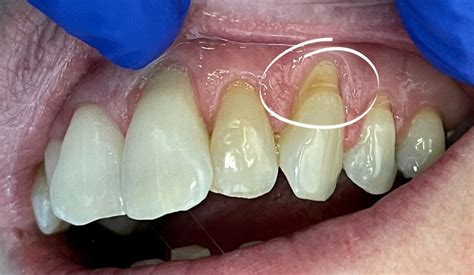 Abfraction Teeth