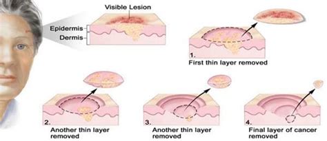 Mohs Surgery Premier Dermatology Atlanta