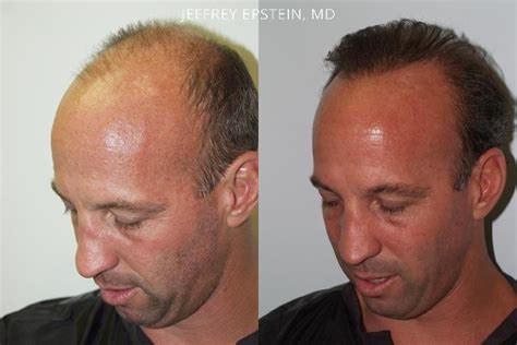 Hair Transplants For Men Pictures Miami Fl Paciente