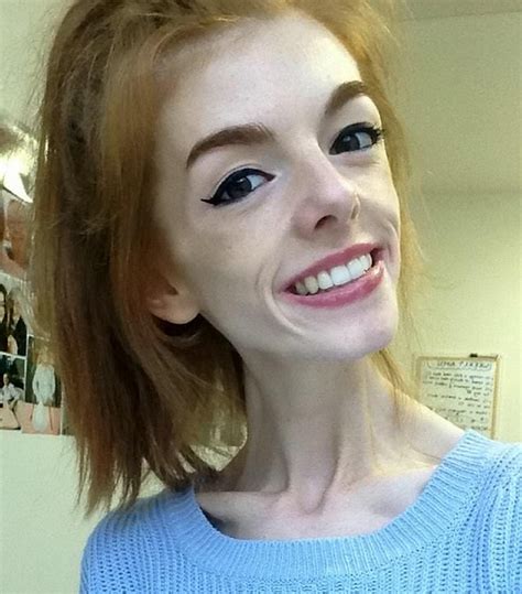 She Weighed 60 Pounds After A 5 Year Long Battle With Anorexia This