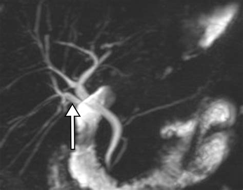 Mr Imaging And Ct Of The Biliary Tract Radiographics