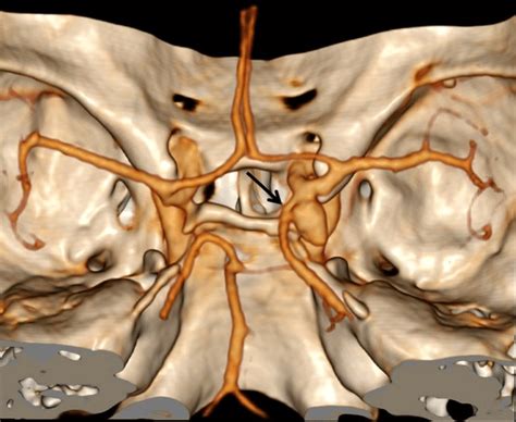 The image demonstrates the presence of aneurysm of right internal... | Download Scientific Diagram