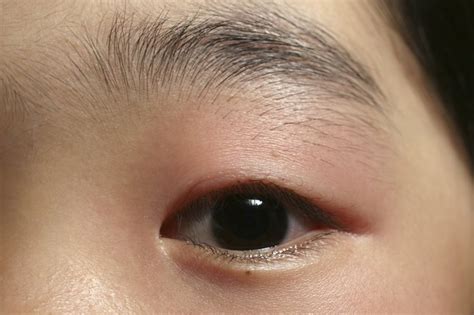 How To Treat A Swollen Eyelid Livestrong Com