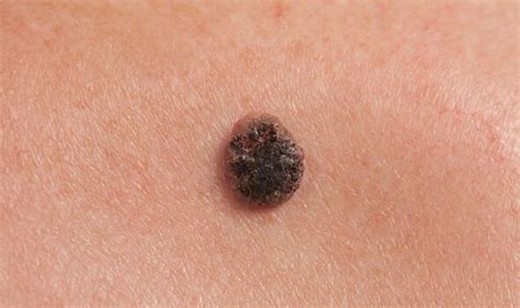 Skin Cancer Symptoms What Does Skin Cancer Look Like 10 Signs To Get