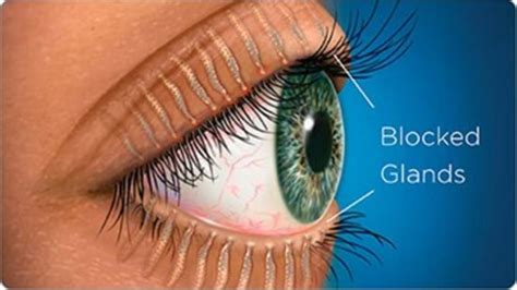 Meibomian Gland Dysfunction Risk Factors Symptoms And Treatment Of