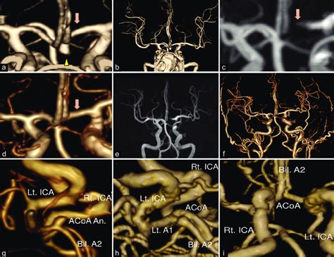 E Preoperative Computed Tomography Angiography Cta Revealed The 40