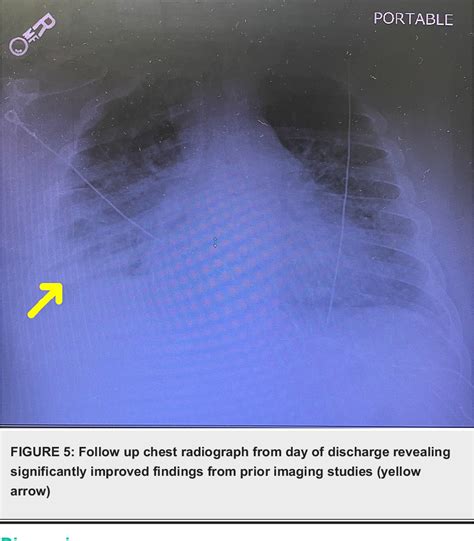 PDF One Lung Ventilation In A Patient With Necrotizing Pneumonia