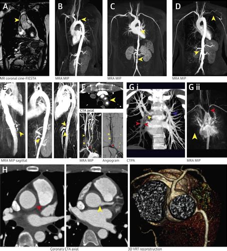 The Impact Of Integrated Noninvasive Imaging In The Management Of