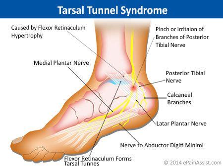 Anatomy Of Foot Pain - ANATOMY