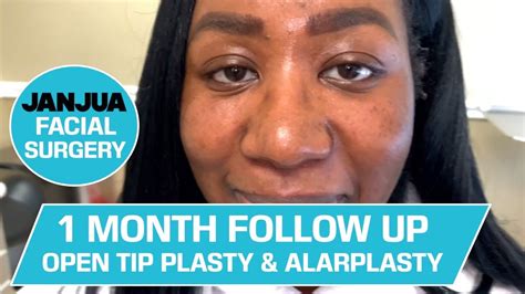 Part 2 Follow Up Open Tip Plasty And Alarplasty Dr Tanveer Janjua New Jersey Youtube