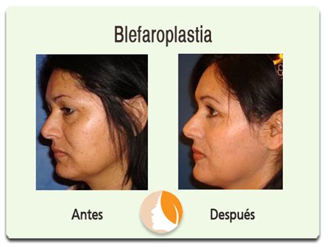 Blefaroplastia Dr Alejandro Campos Apaez