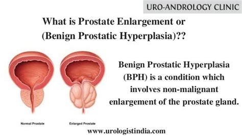 Prostate Enlargement Treatment In Tamil Nadu | Best Urologist In India