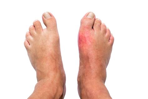 Bunion Vs Gout What Is The Difference Upstep Answers