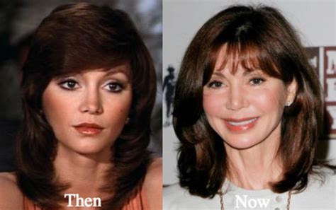 Victoria Principal Plastic Surgery Before and After Photos - Latest ...