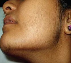 Hirsutism Treatment in Chennai | ID: 8919714873