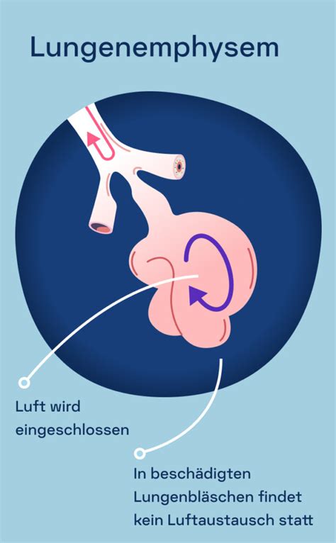 Copd Ursachen Behandlung Und Symptome Kaia Health