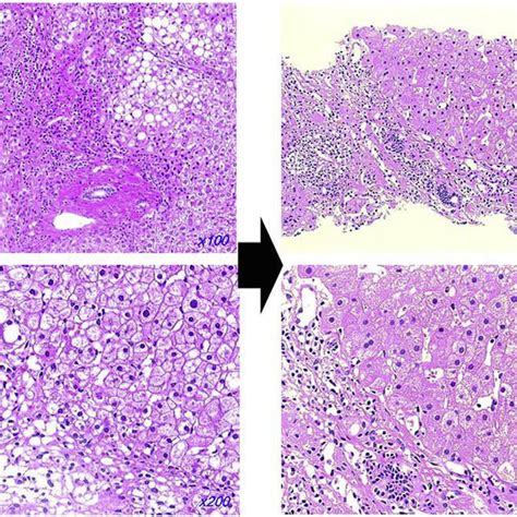 Pathological findings of liver biopsy specimen. A. Liver biopsy ...