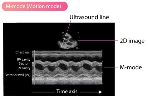 M Mode Motion Mode Echocardiography The Cardiovascular