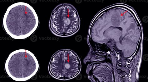 Ct Brain Scan Of A Patient With History Of Mild Head Injury Showing