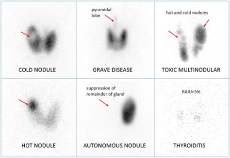 My Notes for USMLE — Thyroid hormone disorders RAIU: RadioActive Iodine...