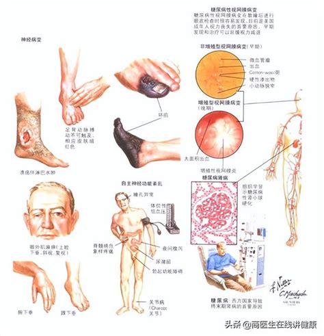 醫生坦言：三種維生素，預防糖尿病及其併發症，有利於糖尿病逆轉 每日頭條