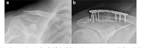 Figure 1 From Arthroscopic Coracoclavicular Button Fixation Versus