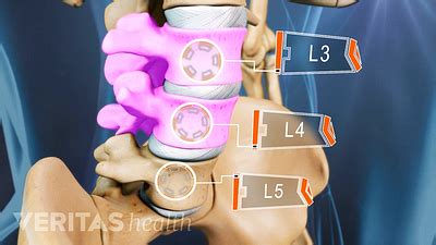 Lumbar Degenerative Disc Disease Video | Spine-health