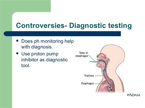 Laryngopharyngeal Reflux