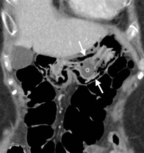 Ct Of Gastric Emergencies Radiographics