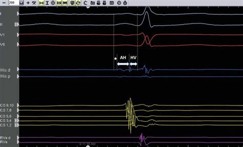 Electrophysiology Study Interpretation Of Intracardiac