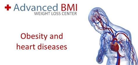 Obesity and heart disease - Advanced BMI Lebanon - Dr Nagi Jean Safa Clinic