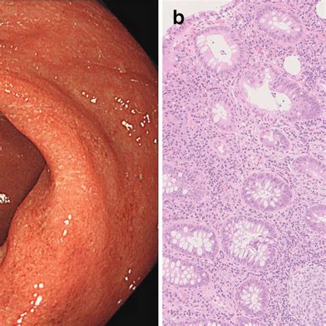 A Endoscopic Image Of Rectum Is Shown B Mucosal Tissue Was Biopsied In Download Scientific