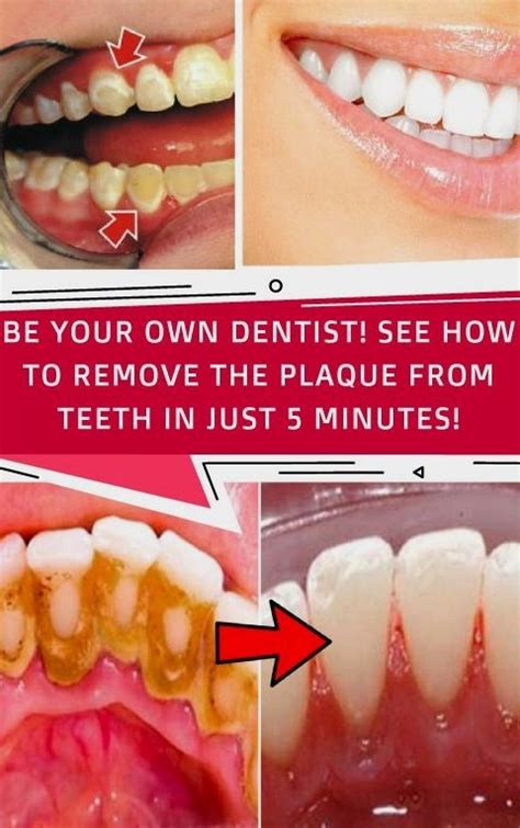 How To Remove Dental Plaque In 5 Minutes Naturally Without Going To The