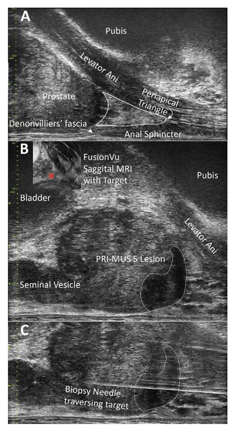 Micro-Ultrasound Guided Transperineal Prostate Biopsy: A Clinic-Based ...